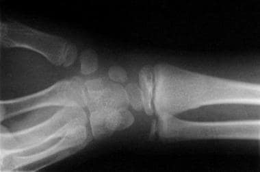 greenstick fracture x ray