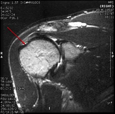 Rotator cuff injury. 