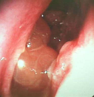 A polypoid recurrence in the center of the ethmoid