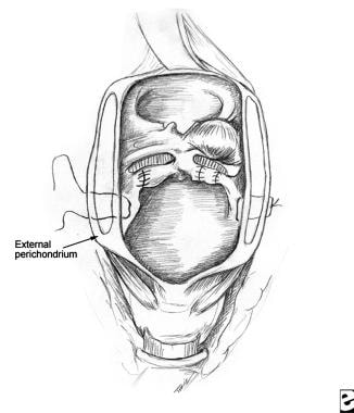 Laryngeal Fracture