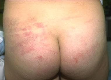 Patterned bruises inflicted with a belt. Image cou
