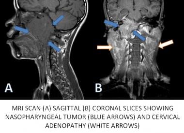 MRI of the head and neck in a patient with nasopha