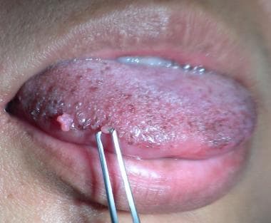 These small papillomas on the lateral tongue of a 
