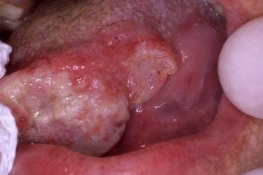 Advanced oral squamous cell carcinoma presenting a
