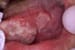 Cancers of the Oral Mucosa