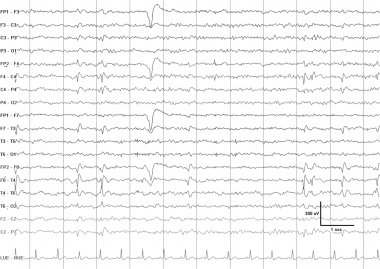 An EEG typical of the syndrome of benign childhood