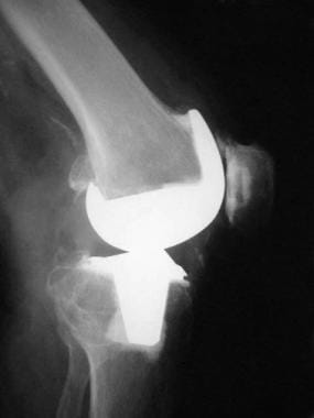 Complications of total knee arthroplasty. Multiple