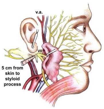 The surgical anatomy and landmarks of the facial n