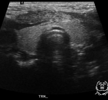 Ultrasound image in the same patient as in the pre