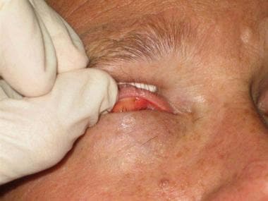 Eversion of the upper eyelid. 