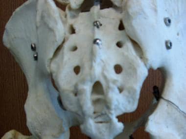 Sacral spine model showing sacral hiatus and entry