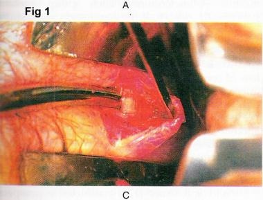 internal anal fissure