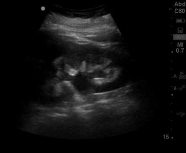 Moderate hydronephrosis, with dilatation of the co