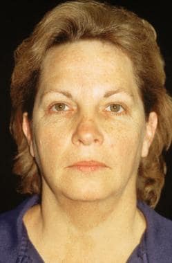 Mid Face Facelift: Overview, Indications, Contraindications