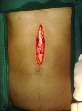 Upper midline incision. Incision is deepened throu