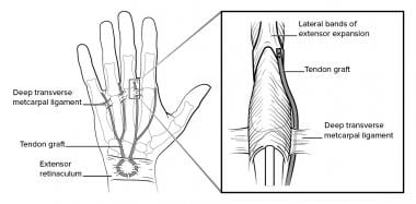 Dorsal tenodesis to control claw deformity. 