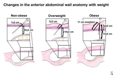 Changes in the anterior abdominal wall anatomy wit