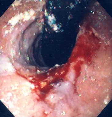 Mallory-Weiss tear with a pigmented protuberance a