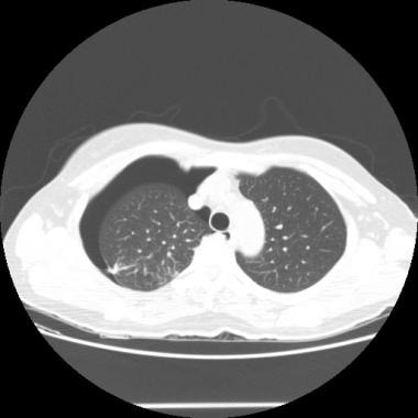 CT scan of chest in same patient with spontaneous 