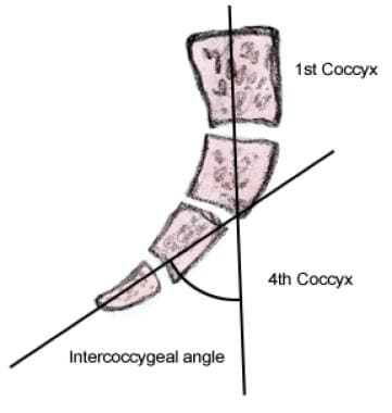 Intercoccygeal angle is angle between midline of  