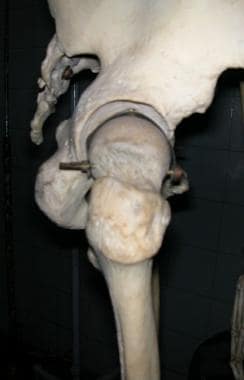 Hip, as seen from lateral side, showing trochanter