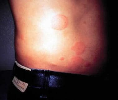 Urticaria developed after bites from an imported f