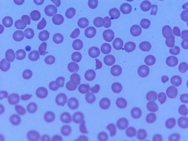 Examination of the peripheral smear shows red bloo