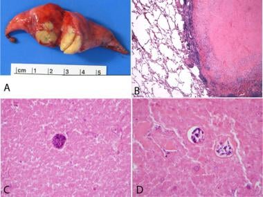 Coccidiomycosis。a）楔形切除肺部