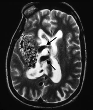 A 44-year-old woman presented with left-sided hemi