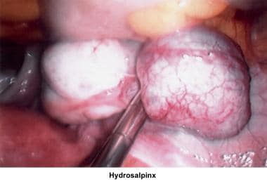 Infertility. Hydrosalpinx. Image courtesy of Jairo