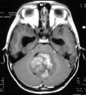 Medulloblastoma. Axial T1-weighted postcontrast im