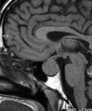 Sagittal T1-weighted MRI shows a nonenhancing pitu