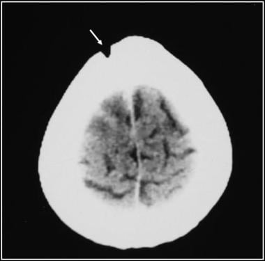A missile injury through the frontal bone associat
