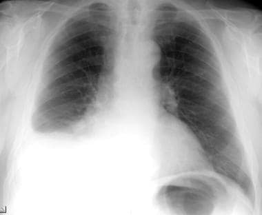 Posteroanterior chest radiograph in a 69-year-old 