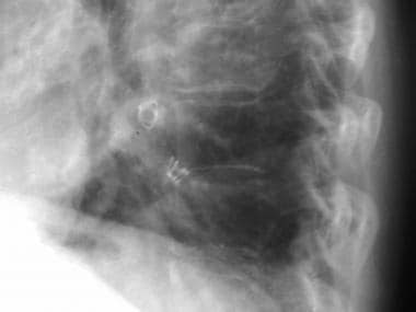 Lateral chest radiograph shows a pulmonary arterio