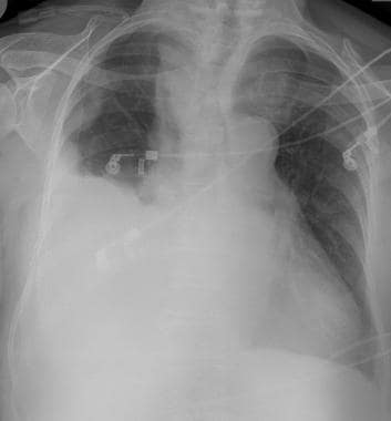 Chest radiograph shows a large pleural effusion an