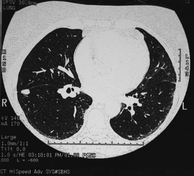 A solitary pulmonary nodule in the right lower lob
