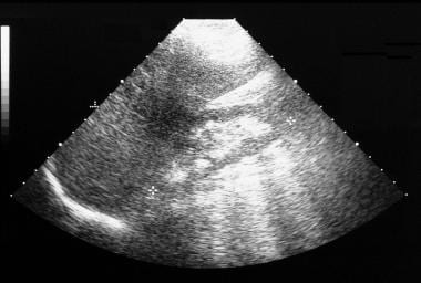 Sonogram of the right kidney in a woman with nephr
