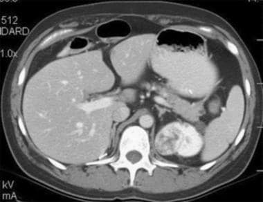 Case 6. Multifocal renal cell carcinoma in a patie