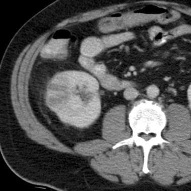 Contrast-enhanced CT image shows a patchy area of 