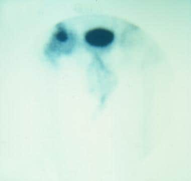 Bone scan of a patient with avascular necrosis of 