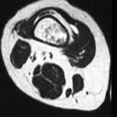 Enchondroma. Axial T2-weighted magnetic resonance 