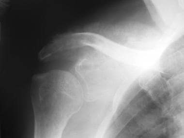 Anteroposterior (AP) radiograph of the shoulder in