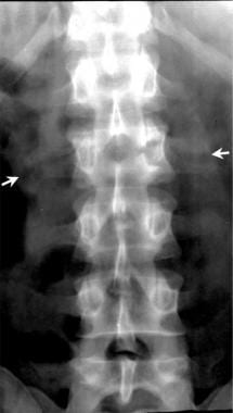 Lumbar spine trauma. Anterior view of a Chance fra