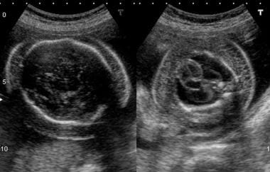 fetal pleural effusion ultrasound