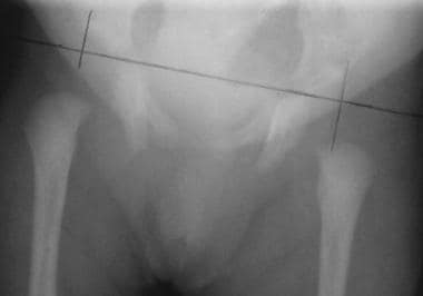 Frontal radiograph of the pelvis obtained in an in