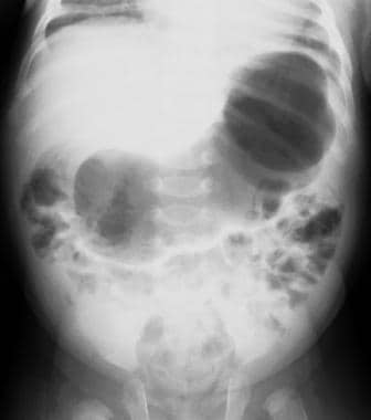 Supine radiograph in an infant with vomiting demon