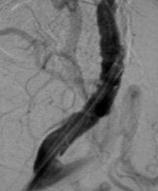 Postangioplasty angiogram demonstrating improved l