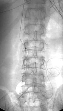 Abdominal radiograph demonstrates a J-wire trapped