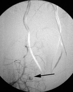 Right iliac artery angiogram (late phase) followin